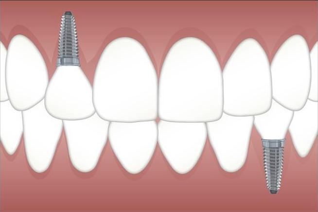 Cirurgia de Implante