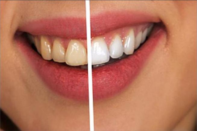 Clareamento Dental