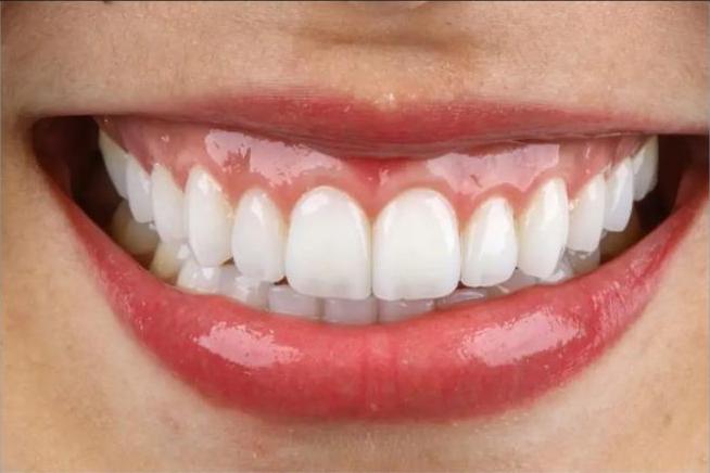 Facetas Estéticas