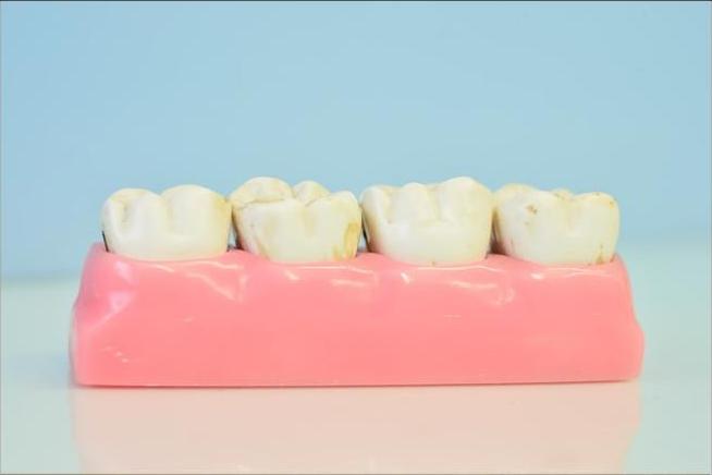 Raspagem Periodontal